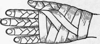 Bandage of the Hand