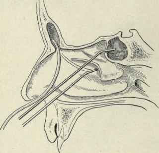 Fig. 125.   Probes introduced into the frontal, maxillary, and sphenoidal sinuses. The anterior portion of the middle turbinate has been removed.