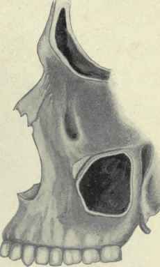 Fig. 126.   Side view of the maxillary and frontal sinuses.