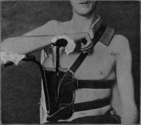 Subdeltoid+bursitis
