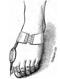 Fig. 406. Apparatus for Treating Bunions.