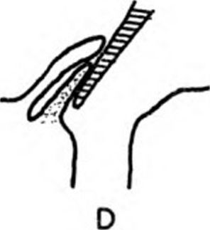 Manner of pushing the valvefold aside and inserting the syringe 3