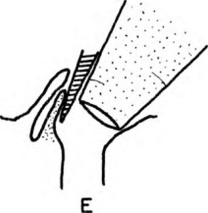 Manner of pushing the valvefold aside and inserting the syringe 4