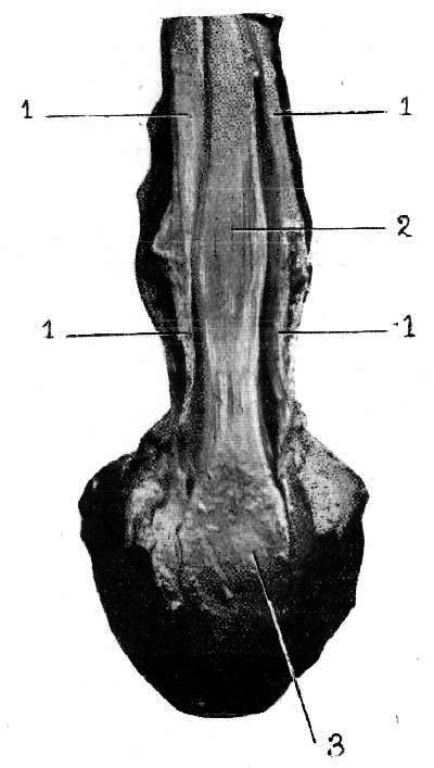 Fig. 11.   The Flexor Perforans And Flexor Perforatus Tendons