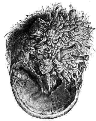 Fig. 134.   A Foot, The Subject Of Canker, Showing Destruction Of The Horny Frog, And A Fungoid Looking Hypertrophy Of The Tissues Beneath