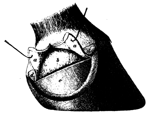 Fig. 139.   Excision Of The Lateral Cartilage (Old Method)