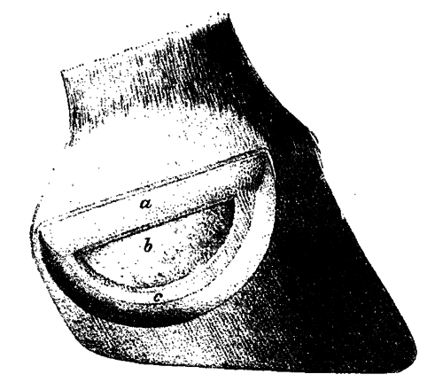 Fig. 140.   Excision Of The Lateral Cartilage
