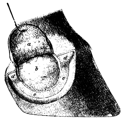 Fig. 141.   Excision Of The Lateral Cartilage