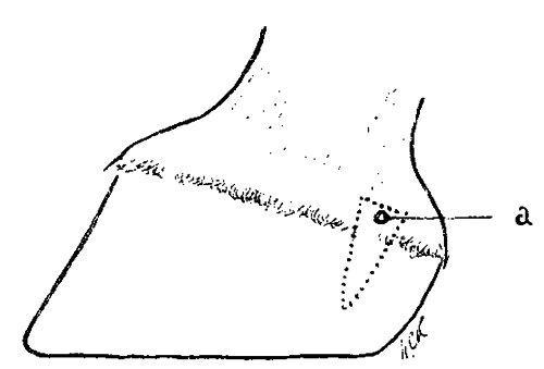 Fig. 142.   Partial Excision Of The Lateral Cartilage By Removing A Portion Of The Coronary Cushion