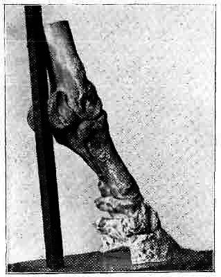 Fig. 150.   Effects Of Periostitis On The Pedal And Navicular Bones