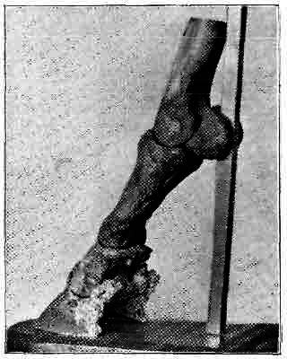 Fig. 151.   Effects Of Periostitis On The Pedal And Navicular Bones