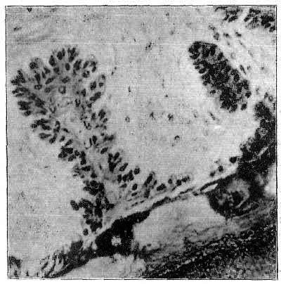 Fig. 29.   Section Of An Epithelial Ingrowth From An Equine Foetus
