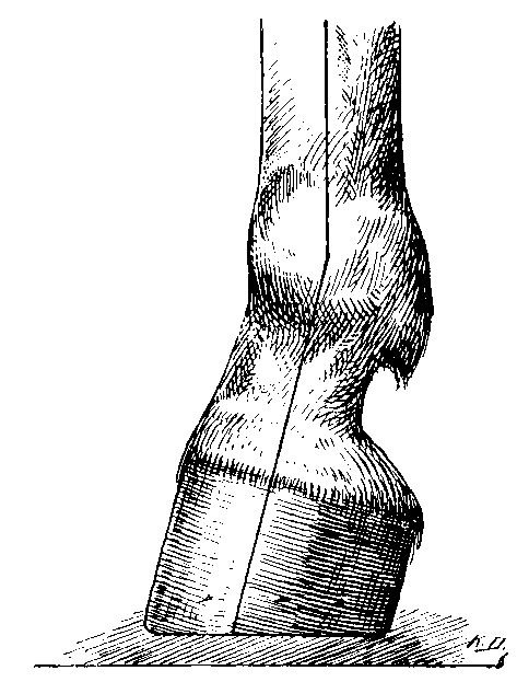 Fig. 83.   The Club Foot