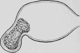 Stone Empouched in the Fundus, and extending into the Cavity of the Bladder.