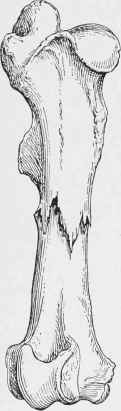 Impacted Fracture of Femur.