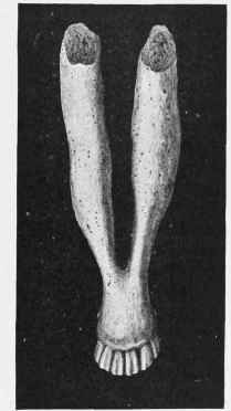 Osteo porosis Lower Jaw affected by the disease.