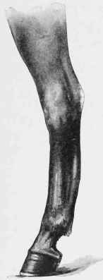Sprain of the Perforans and Perforatum Tendons.