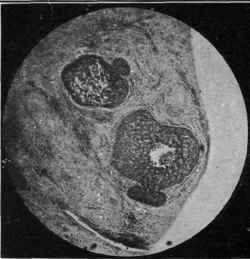 Fig. 9. Adeno Carcinoma (Cancer)