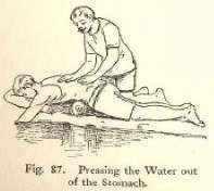 Fig. 87. Pressing the Water out of the Stomach.