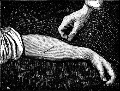 FIG. 4.   AN ARM TRANSPIERCED BY A NEEDLE.