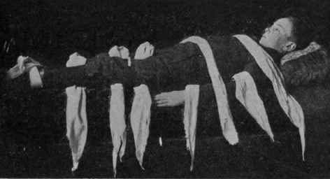 Fig. 5. For a fractured thigh the bandages should first be applied in this manner