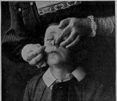 Fig. I. Removing a glass bead from the nostril