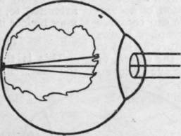 The normal eye, in which the rays of light pass through the lens and are focussed on the retina