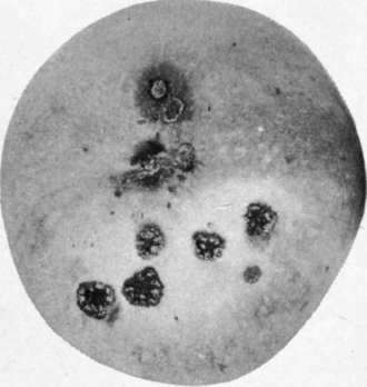 Fig. 2.   Apple scab, margins of spots showing uplifted cuticle. Lesions about blossom   end.