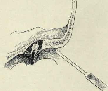 Fig. 109.   Chiselling away the spur of bone between the roof of the external auditory meatus and attic or epitympanum.