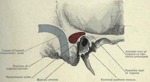 Fig. 110.   Lateral view of the temporal bone, showing the relations of the lateral or transverse sinus and mastoid antrum.