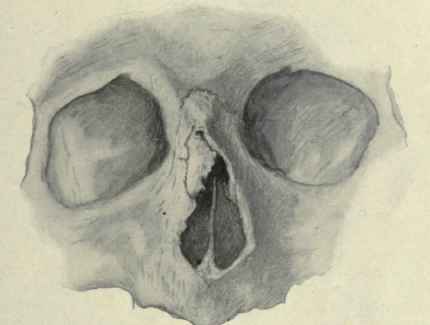 Fig. 113.   Fracture of the nose with deflection of the nasal bone laterally.