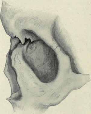 Fig. 114   Fracture of the nose showing depression of the nasal bone.