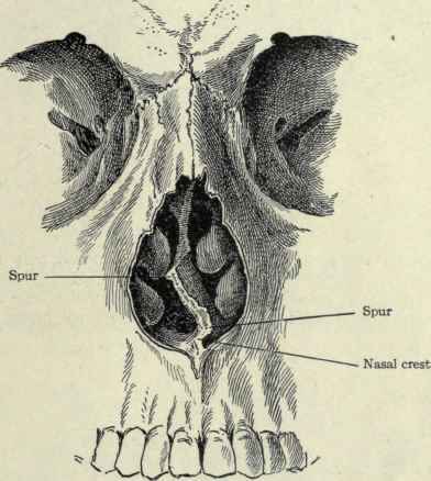 Fig. 118.   Nasal crest and septal spurs.