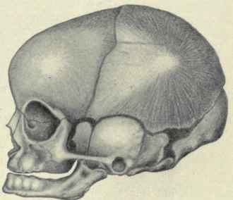 Fig. 12.   Infant's skull, showing anterolateral and posterolateral fontanelles.