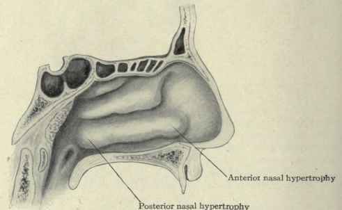 Fig. 120.   View of anterior and posterior hypertrophies of the inferior turbinate.
