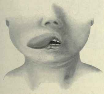 Fig. 128.   Angioma involving the right half of the upper lip in a child. (Personal sketch).