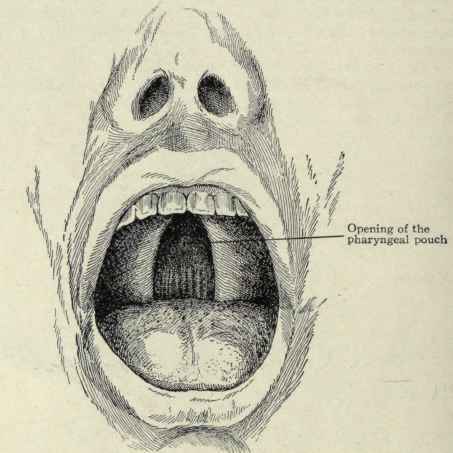 Fig. 139.   Cleft palate, showing the opening of the pharyngeal pouch on the posterior wall.
