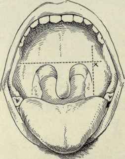 Fig. 143.   Point of puncture for tonsillar abscess.