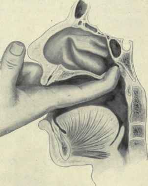 Fig. 149.   Palpation of the posterior nares and pharyngeal tonsil.