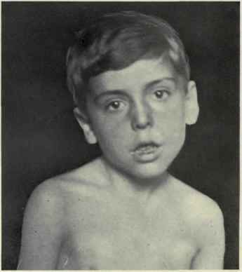 Fig. 170.   Torticollis or wry neck.