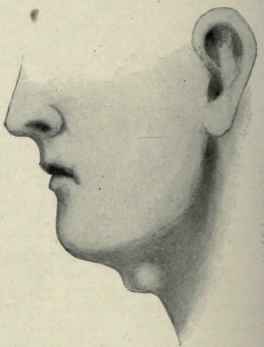 Fig. 191.   Median cervical (thyroglossal) cyst.   Author's case.