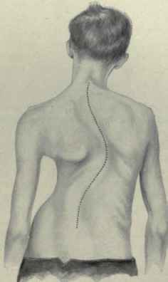 Fig. 197.   Scoliosis, or lateral curvature of the spine.