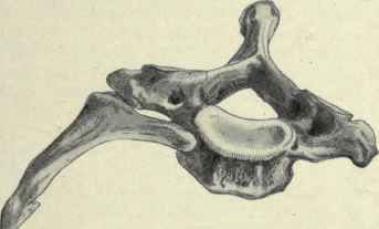 Fig. 198.   A cervical rib attached to the right side of the seventh cervical vertebra.