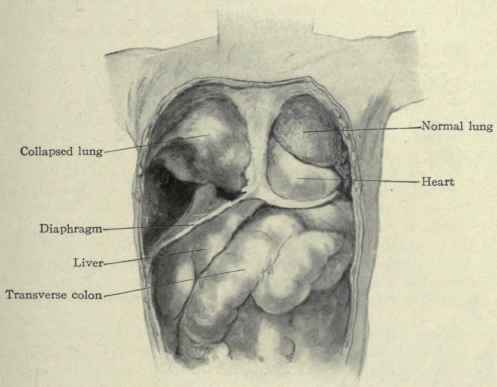 Fig. 217.   Formalin hardened body, showing the right lung collapsed and compressed by a large pleural effusion.