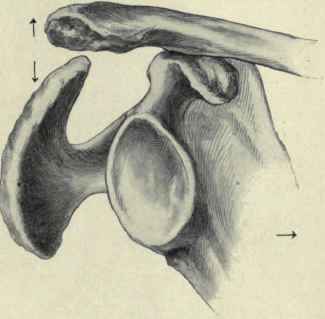 Fig. 244.   Luxation of the outer end of the clavicle upward, showing the coracoid process acting as a fulcrum. As the outer end of the clavicle rises, the lower angle of the scapula is carried toward the median line and the acromion process is depressed and torn loose from the clavicle above.
