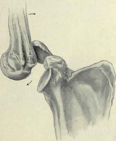 Fig. 245.   Dislocation of the shoulder; action of the bones; by extreme abduction of the humerus over the acromion process as a fulcrum the head is levered out of the socket.