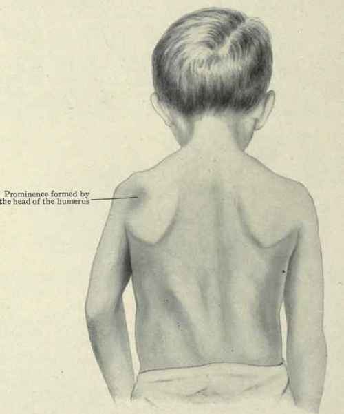 Fig. 255.   Posterior luxation of the shoulder. The head of the humerus makes a prominence beneath the spine of the scapula and the arm is rotated inward. (From a photograph of author's patient by Dr. A. P. C. Ashhurst).