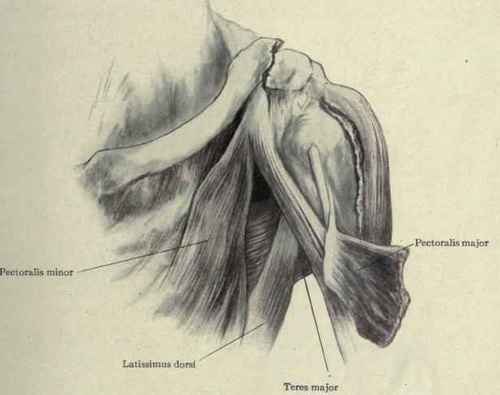 Fig. 259.   Fracture of the outer end of the clavicle. The outer fragment is drawn inward by the pectoralis major latissimus dorsi, and teres major muscles.