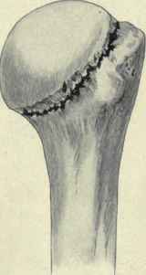Fig. 260.   Fracture through the anatomical neck of the humerus.