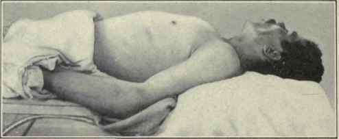 Fig. 276.   Subpectoral abscess.